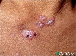 Lupus, discoid  - view of lesions on the chest