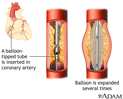 As Charles Keasing filosofie Coronary artery balloon angioplasty - series | Lima Memorial Health System