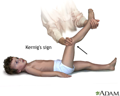 Kernig's sign of meningitis