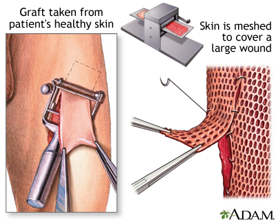 Skin graft
