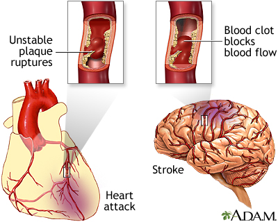 Plaque buildup in arteries