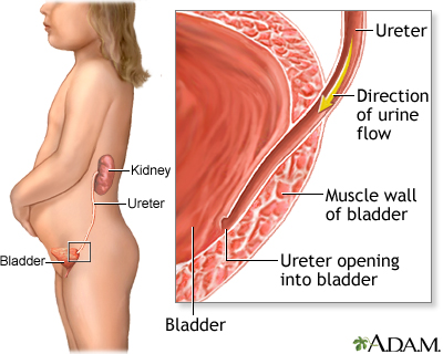 Vesicoureteral reflux