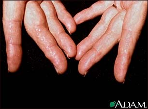 Amyloidosis of the fingers