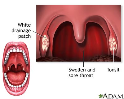 Tonsillitis | Lima Memorial Health System