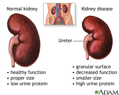 when does diabetes affect the kidneys