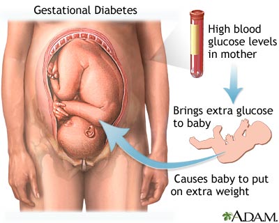 Gestational Diabetes