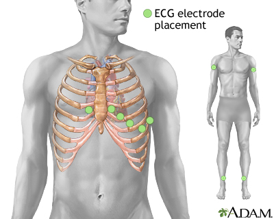 ECG electrode placement