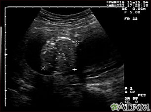 Ultrasound, normal fetus - abdomen measurements