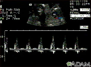 Ultrasound, ventricular septal defect - heartbeat