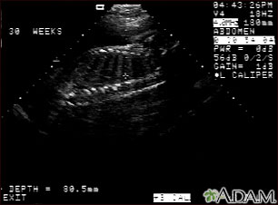 Ultrasound, normal fetus - spine and ribs