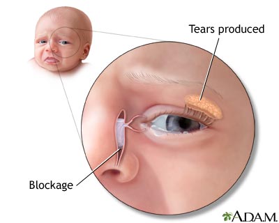 Blocked tear duct