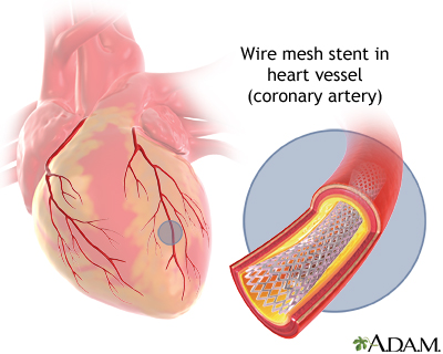 Angioplasty and stent placement - heart | Lima Memorial Health System