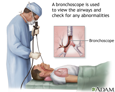 Bronchoscopy