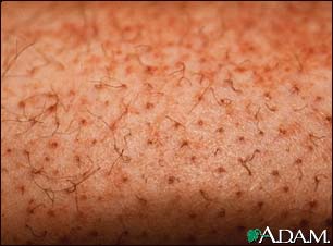 Scurvy - corkscrew hair