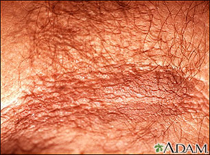 Acanthosis nigricans - close-up