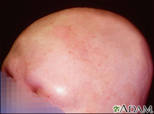 Alopecia totalis - front view of the head