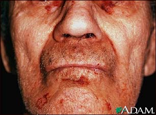 Amyloidosis of the face