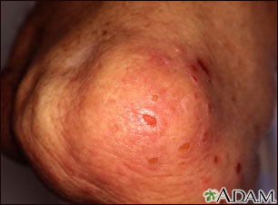 Dermatitis - herpetiformis on the knee