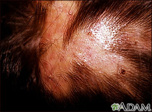 Folliculitis - decalvans on the scalp