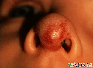 Hemangioma on the face (nose)