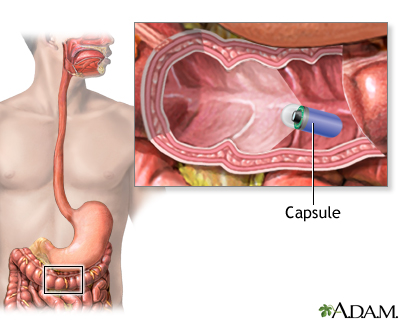 Capsule endoscopy