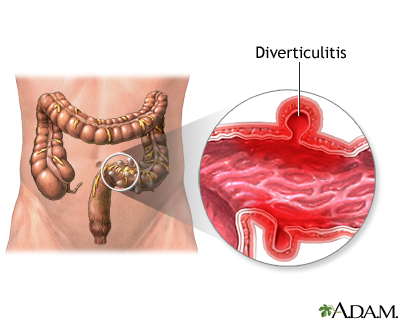 Diverticulitis