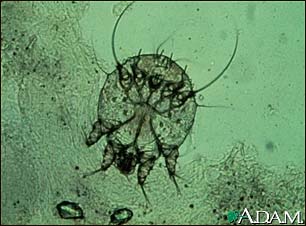 Scabies mite - photomicrograph