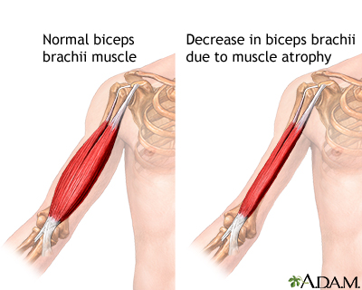 Muscular atrophy