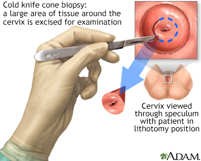 Cold knife cone biopsy