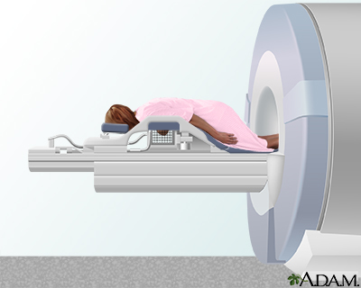 Breast MRI scan