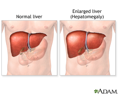 Hepatomegaly