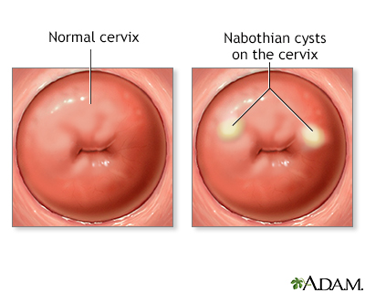 Nabothian cysts