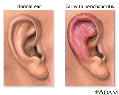 Perichondritis