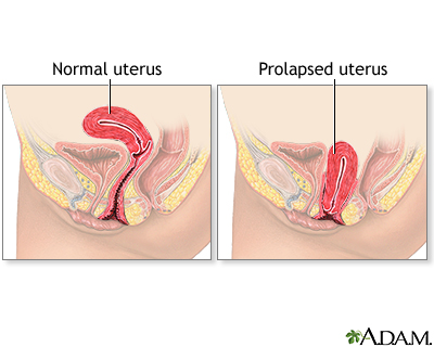 Uterine prolapse