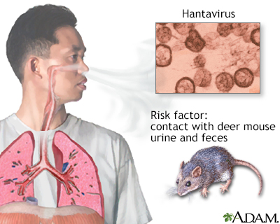 Hantavirus
