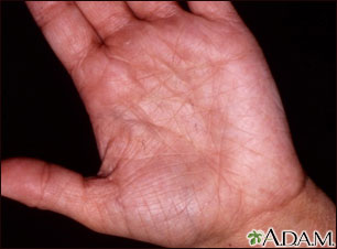 Hyperlinearity in atopic dermatitis