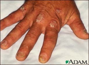 Psoriasis on the knuckles