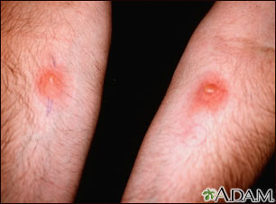 Skin testing - PPD (R arm) and Candida (L)