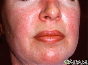 Dermatomyositis - heliotrope rash on the face