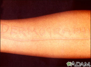 Dermatographism - arm