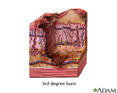 Third degree burn