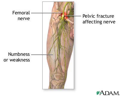 Femoral nerve damage