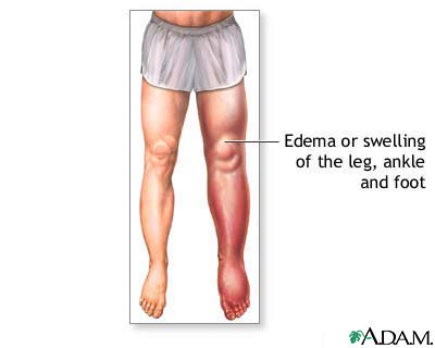 Lower leg edema