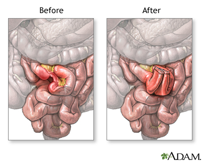 Before and after small intestine anastomosis