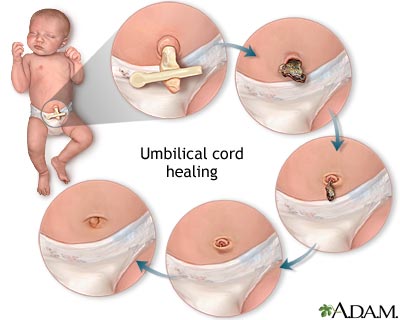 Umbilical cord healing