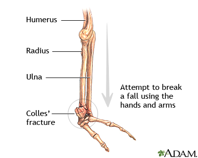 Colles Fracture: Causes, Symptoms & Treatment · Dunbar Medical