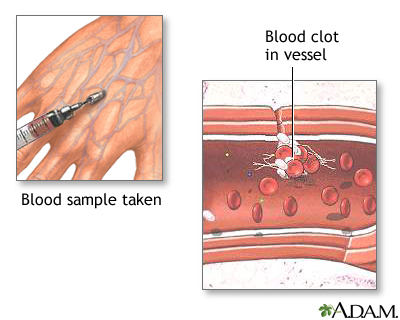 Blood clots