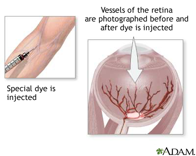 Retinal dye injection