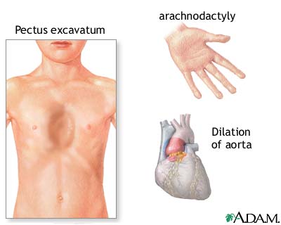 Marfan syndrome