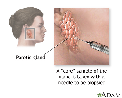 Salivary gland biopsy